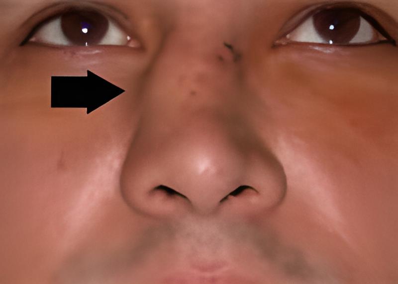 Sono molti i traumi nasali in cui si può incorrere. Nella foto, una deviazione del setto nasale.